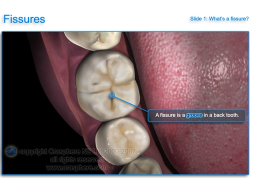 Mean scores for dental caries in the mandibu- lar molars of each group.