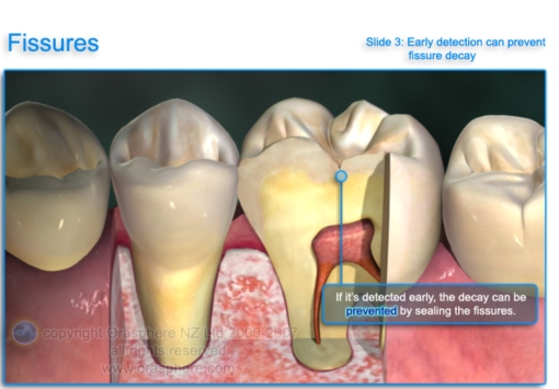 deciduous teeth susceptible caries