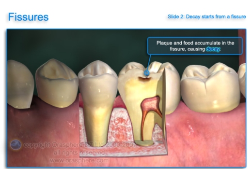 remineralization teeth definition