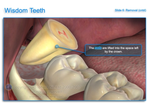 how long after wisdom teeth extraction should the bleeding stop